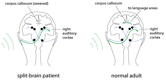 split brain patients